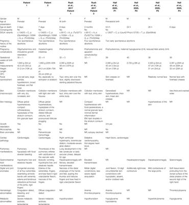 Fatal Neonatal DOLK-CDG as a Rare Form of Syndromic Ichthyosis